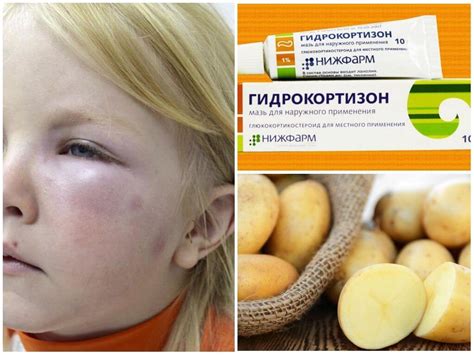 В глаз укусила мошка: как снять отек, первая помощь, как лечить ...