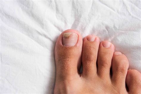 types  toenail fungus