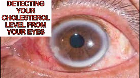 DETECTING YOUR CHOLESTEROL LEVEL FROM YOUR EYES - YouTube