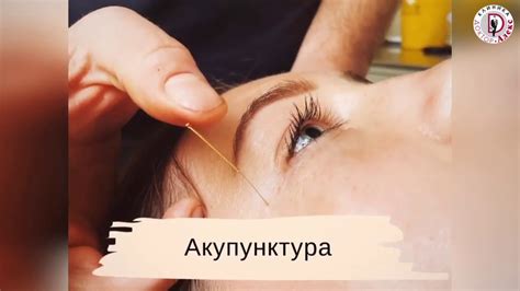 Акупунктура в лечении и реабилитации - YouTube