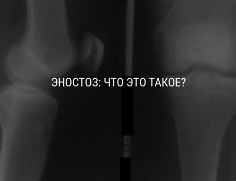 Эностоз: что это такое, как лечить эностоз кости, виды эностоза