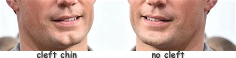 Cleft Chin Myths