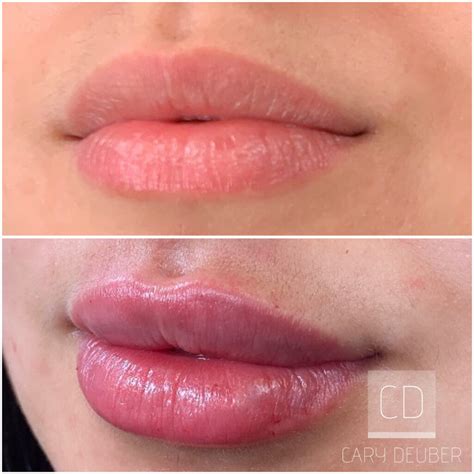 cary lip filler  lemmon avenue plastic surgery laser center dr