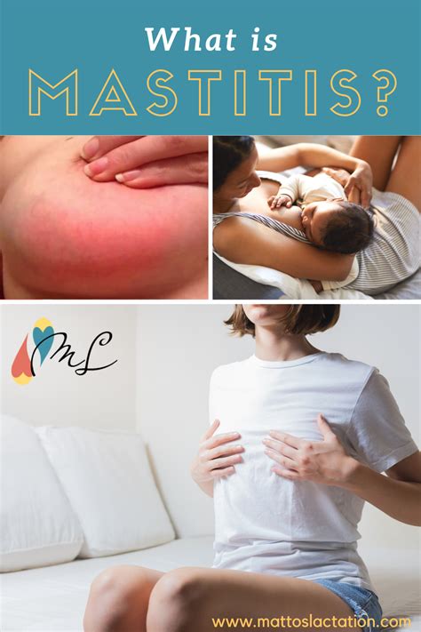 Everything you need to know about Mastitis | Mastitis, Breastfeeding ...