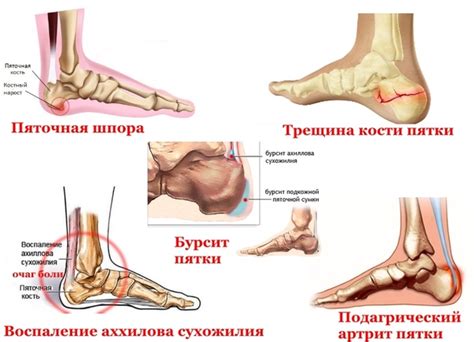 Пяточная кость: строение и возможные заболевания