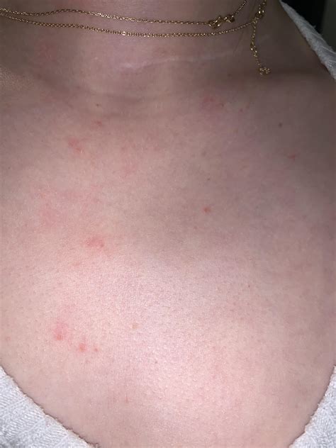 Are these head lice bites on my chest area? : Lice