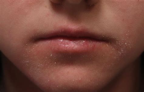 Eczema On Lips: Causes, Treatment Options, & Prevention Tips