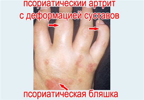Псориаз: причины, симптомы, виды, стадии, лечение