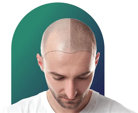 hair transplant  kochi  calicut bhc hair transplant kerala