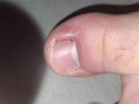 Are these ingrown toenails?? : r/Ingrown_Toenails
