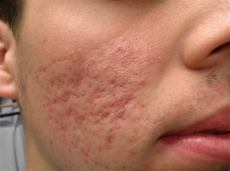 ACD A-Z of Skin - Acne Scars (Acne Scarring)