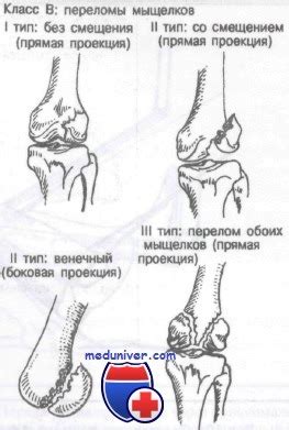 Переломы мыщелков бедренной кости - клиника, диагностика