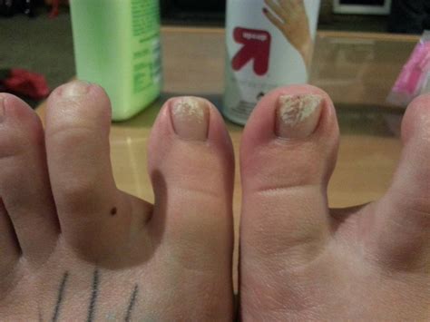 Nail Polish On Bruised Toenail at Brenda Ferri blog