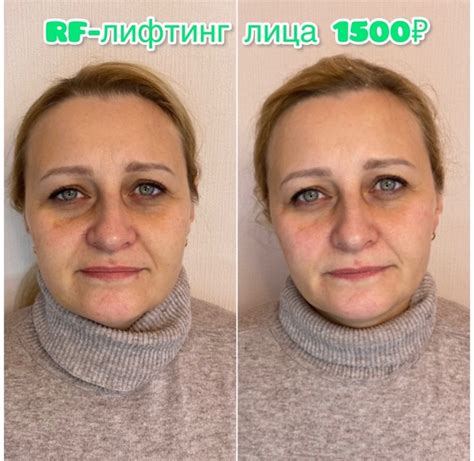 Чудеса от процедуры RF-лифтинга лица До/После всего 1 процедуры ...