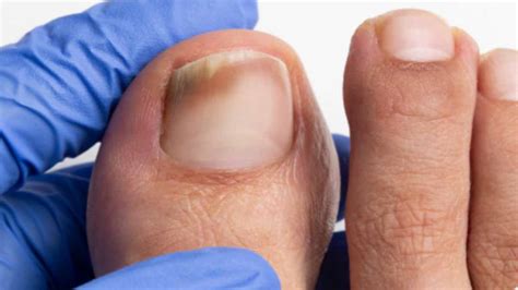 Mycose des ongles: Une astuce miracle qui la surmonte facilement ...