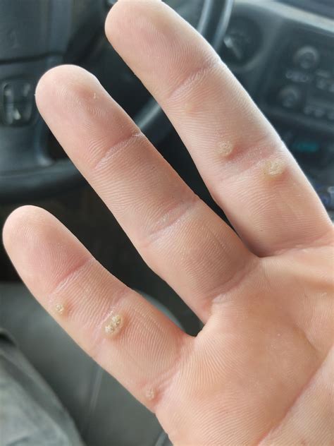 Removal tips? I've thought about torching them off but I'm not