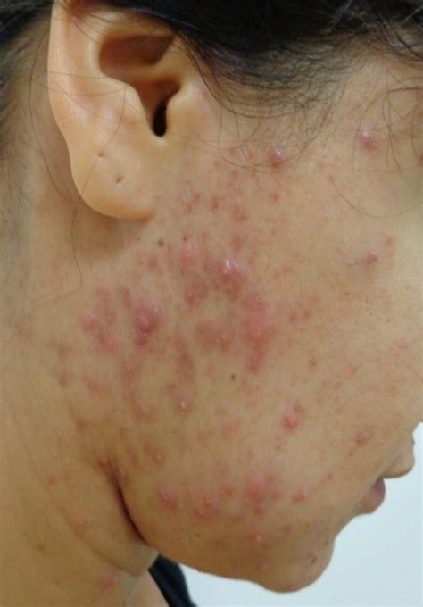 Hormonal Acne Neck