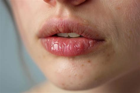Labios Queimando E Ardendo - Lábios Ressecados e Ardendo: Causas e Soluções Eficazes