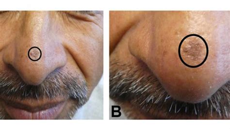 skin cancer  face early signs