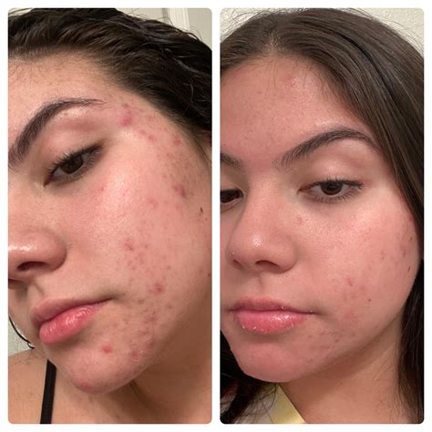 Bleach Bath Eczema Before And After at James Joslin blog