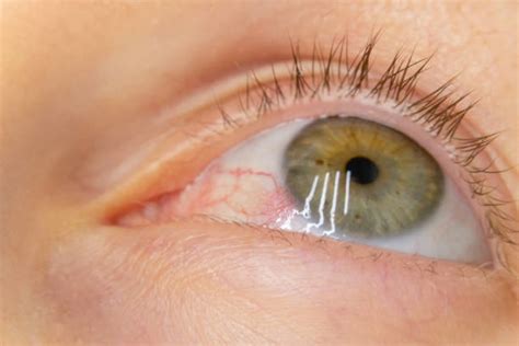 Bulging Cornea Stock Photos, Pictures & Royalty-Free Images - iStock