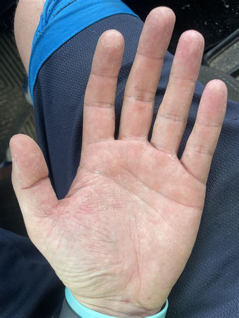 Extremely dry, itchy, and flaky skin on hands. : r/DermatologyQuestions