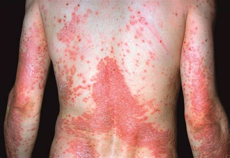 Psoriasis Treatment