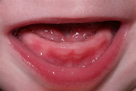 File:Teething.jpg - Wikimedia Commons