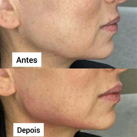 Contorno Mandibular Antes E Depois - Preenchimento Mandíbula Antes e Depois - Clínica Fit Body Estética