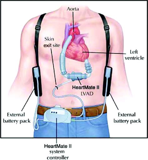 Ventricular Assist Devices | Circulation