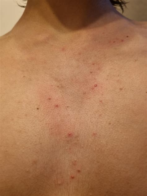 (5 meses e pouco na T) O que fazer com espinhas pelo corpo? : r/transbr