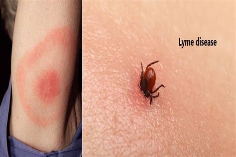 What is Lyme Disease? – Causes, Symptoms, Diagnoses, and More