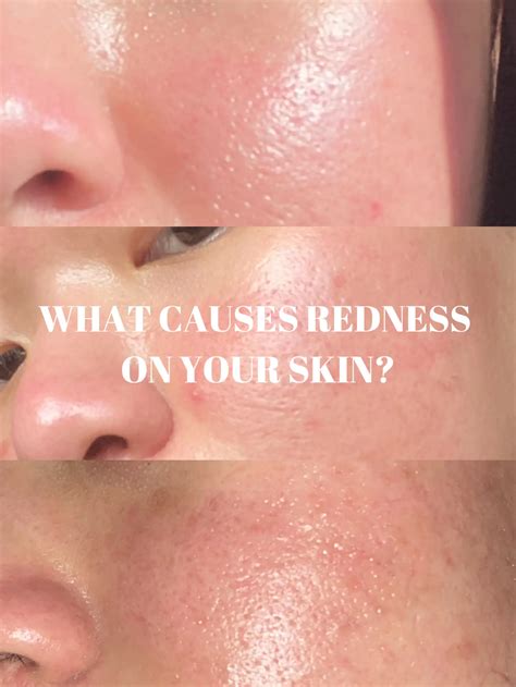 WHAT CAUSES REDNESS ON YOUR SKIN? 😚 | Gallery posted by Ayza Roslan