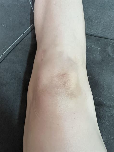 Discoloration 7 months post op? The discoloration on the right side