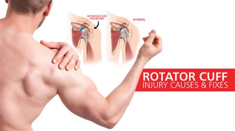 Rotator Cuff Injury Causes Signs Symptoms Diagnosis And Treatment ...