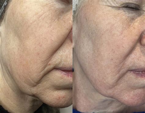 fractionated  laser  laser skin resurfacing  sculptra facial