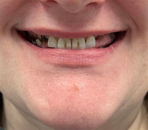 We do many full arch cases and they’re all beautiful and life changing