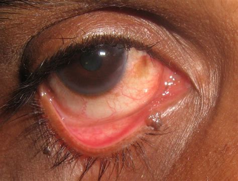 Anand Eye Institute | Eye Care Center | AEI