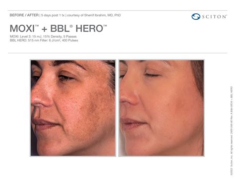 Moxi Treatment Denver CO - Laser Treatment Denver CO