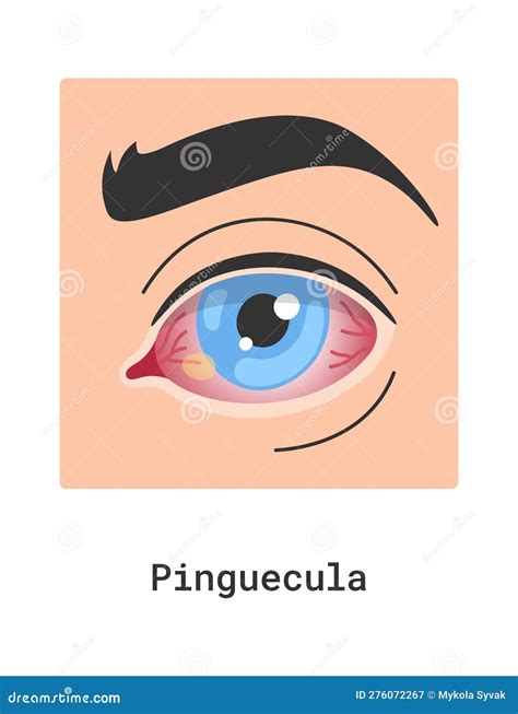 Pinguecula Human Eye Disease Stock Vector - Illustration of pinguecula