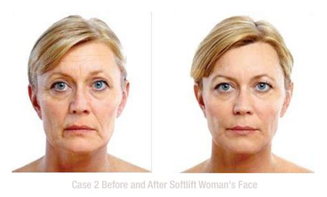 DIY Botox Mask