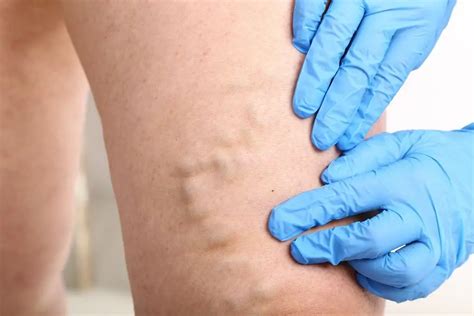 Varicosis: causes, symptoms and treatment | Health