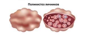 Поликистоз яичников: причины и лечение