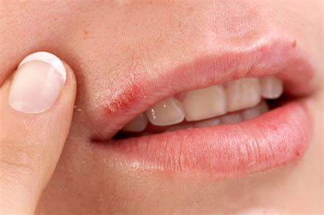 how to cover cold sores 1