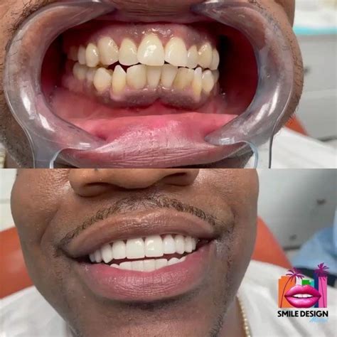 Smile Design by Dr. Becerra on Instagram: “What is a veneer? A veneer ...
