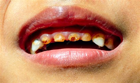 Dente Sujo De Criança - Cárie dentária em uma criança, nos dentes da frente. Conceito de ...