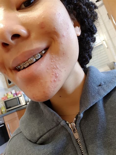 Closed Comedones! : r/acne