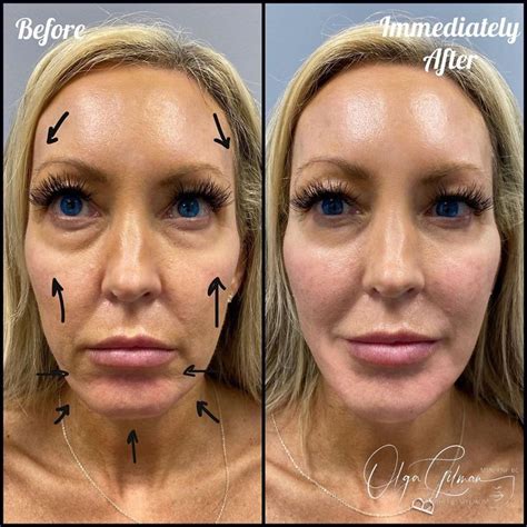10 Thread Lift Before & After Pictures | Thread lift, Thread lift face ...