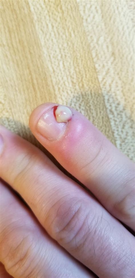 I've been trying to pop this infected hangnail for a week. The relief