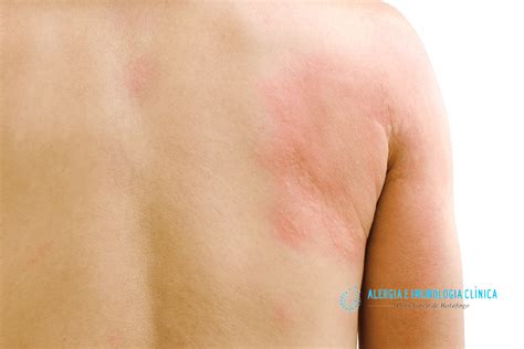 Alergia Na Pele Que Coça E Fica Vermelho - 6 tipos de alergia na pele, causas e tratamento. - Alergia Botafogo